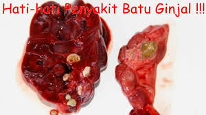 Illustration for article titled Sakit Ginjal dan Batu Ginjal